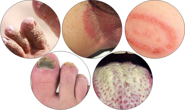 Fungal Infection – Kakadiya Skin And Cosmetic Clinic